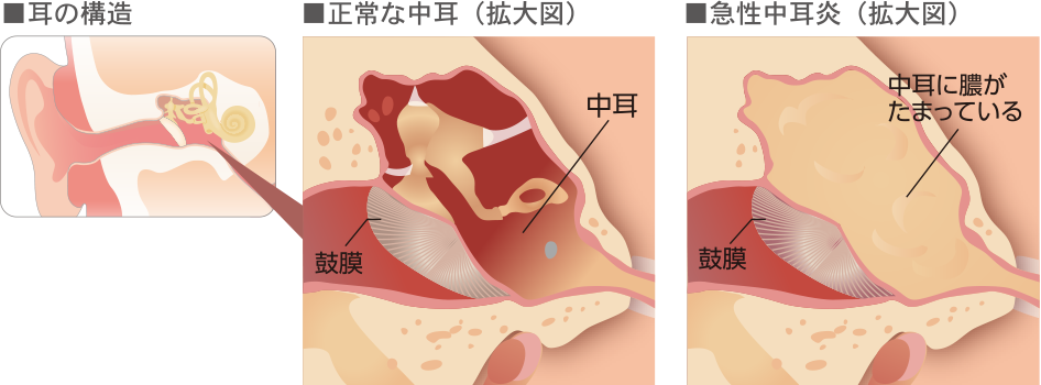 急性中耳炎