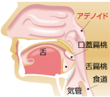 アデノイド肥大 イラスト02